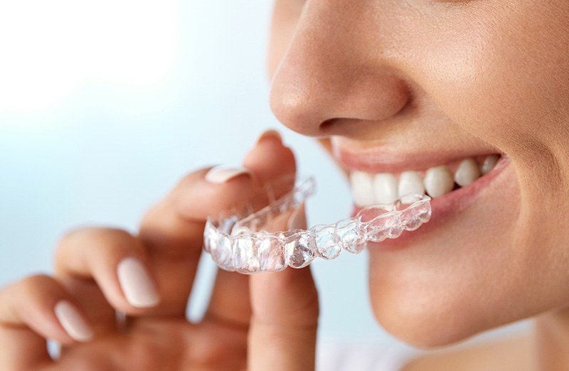 Clear Aligners