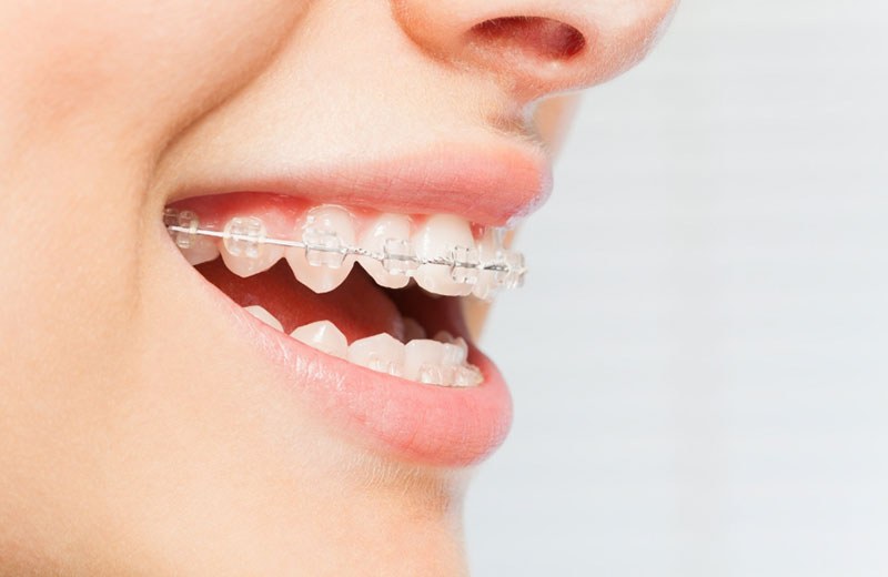 Teeth Braces