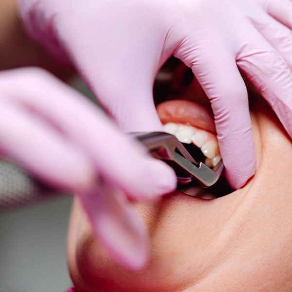 A dentist fitting braces