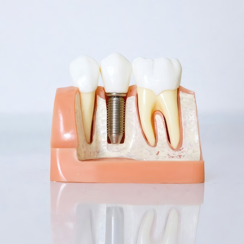 A model of a dental implant beside natural teeth