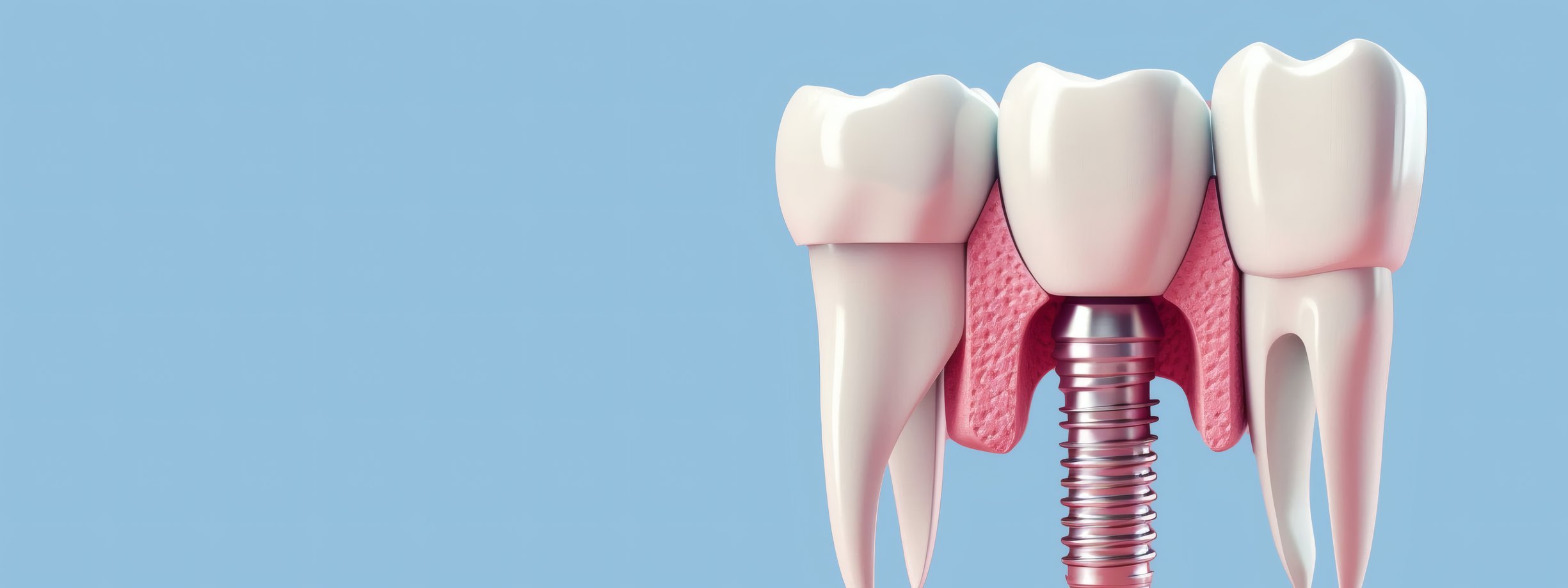 Implant Restorations