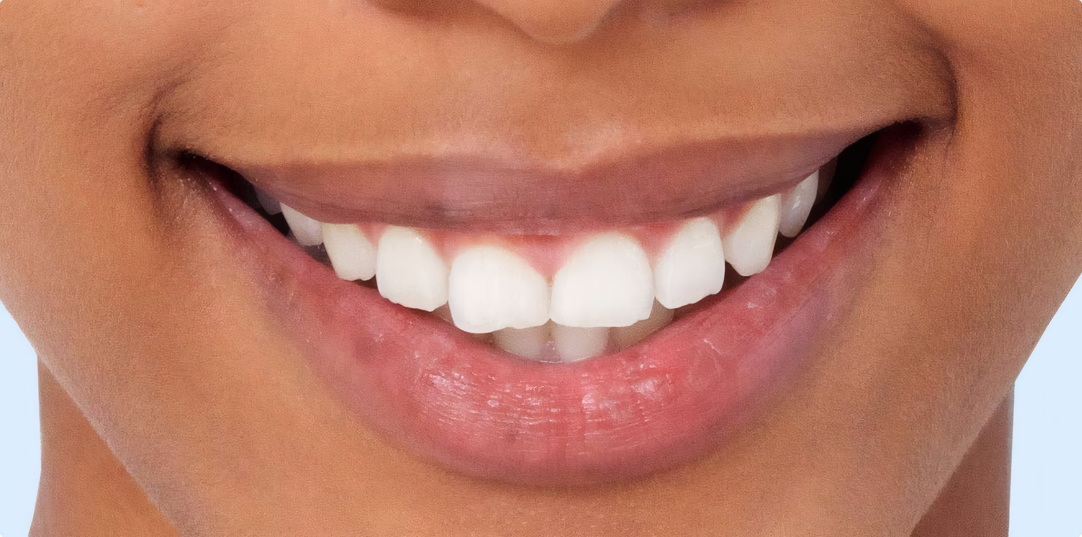 The same teeth after whitening
