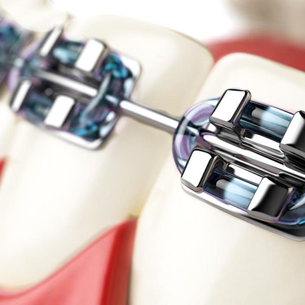Fixed Braces